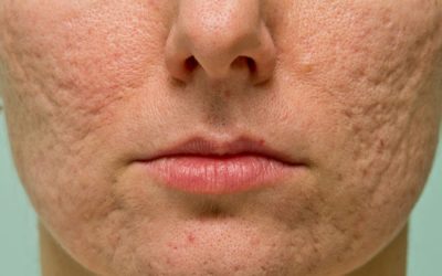 How does Microdermabrasion help Acne ?