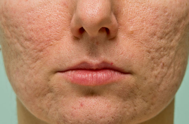Microdermabrasion for Acne