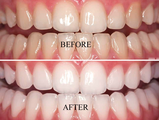 teeth whitening toronto